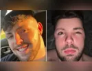 Homem faz sexo após transplante capilar e fica com rosto deformado