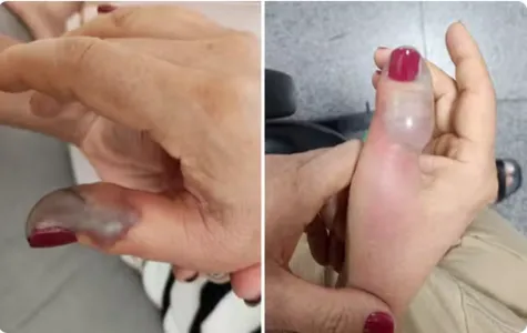 A idosa perdeu parte do dedo.