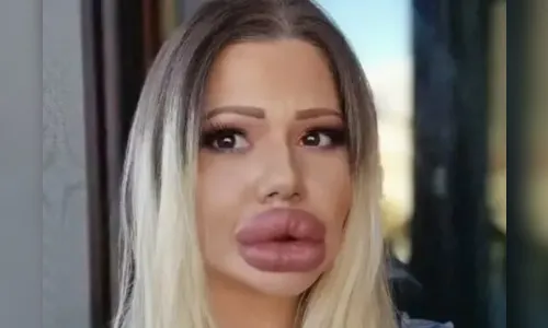 Mulher com maiores lábios do mundo: dentistas não querem atendê-la