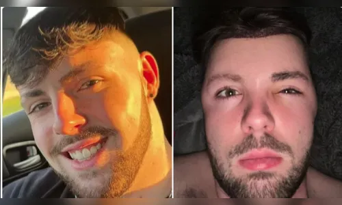 Homem faz sexo após transplante capilar e fica com rosto deformado