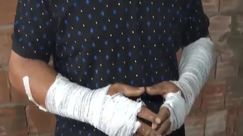 Homem disse que criminosos queimaram seus braços, mas ele mesmo causou ferimentos