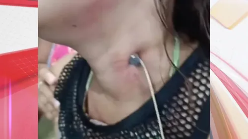 Mulher foi levada ao hospital com prego cravado no pescoço