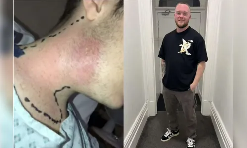 Jovem passa por duas cirurgias após espremer espinha no pescoço
