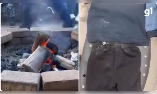 Criança de 3 anos tem queimaduras de 2° grau ao cair em fogueira