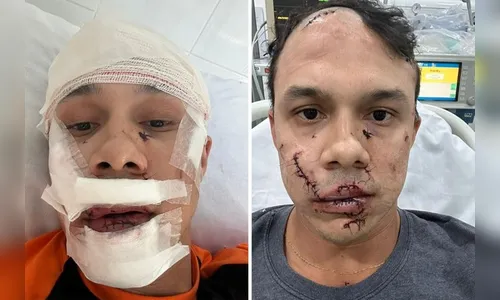 Personal trainer leva 45 pontos no rosto após ser agredido ao defender vítimas de assédio