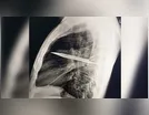 Homem sente dor no peito e descobre faca enfiada no corpo há 8 anos