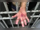 Veja como ficou a mão do agressor após dar 61 socos na cara de mulher