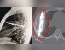 Homem vai ao médico e descobre faca alojada no peito há 8 anos