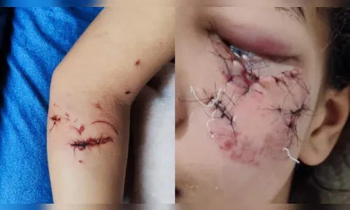 Criança de 11 anos sofre ataque de cachorro em Califórnia no PR