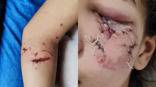 A criança precisou ser hospitalizada.