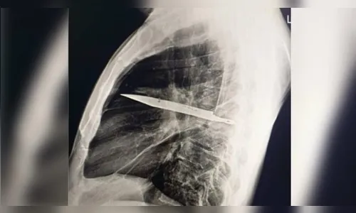 Homem sente dor no peito e descobre faca enfiada no corpo há 8 anos