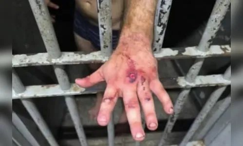 Veja como ficou a mão do agressor após dar 61 socos na cara de mulher