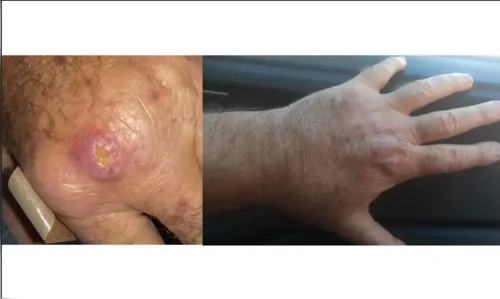 Especialistas alertam para a falta de informação sobre a leishmaniose