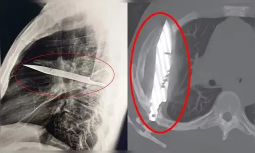 Homem vai ao médico e descobre faca alojada no peito há 8 anos