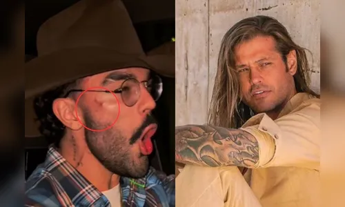 Luan Pereira surge com o rosto machucado após treta com Dado Dolabela