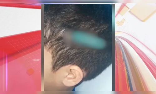 Briga escolar termina com lápis ‘fincado’ na cabeça de criança