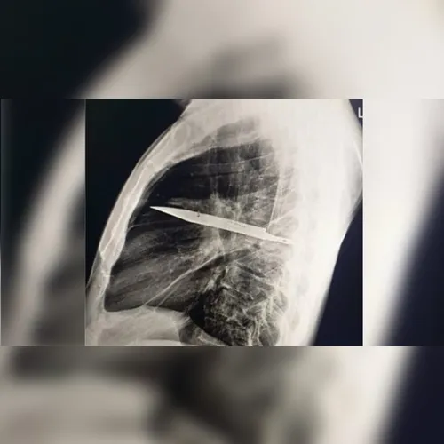 Homem sente dor no peito e descobre faca enfiada no corpo há 8 anos