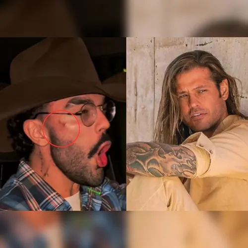 Luan Pereira surge com o rosto machucado após treta com Dado Dolabela
