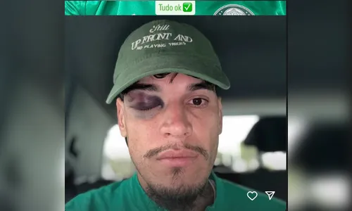 Gustavo Gómez exibe olho roxo após pancada contra o River