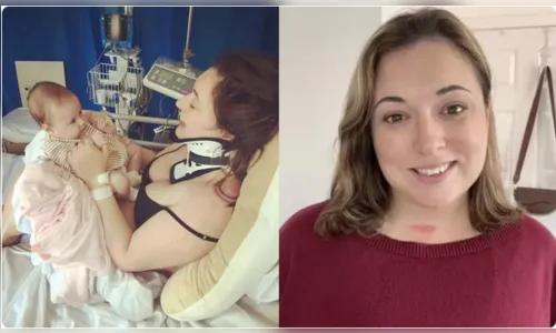 Mulher quebra o pescoço ao bocejar 