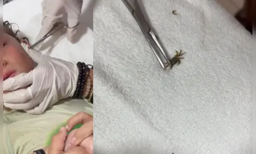Caranguejo vivo é retirado do ouvido de criança após mergulho no mar