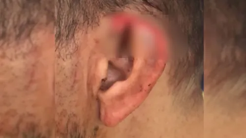 O suspeito mordeu e arrancou parte da orelha da vítima