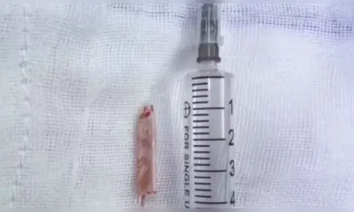 Mulher choca ao descobrir termômetro alojado em nádega por 22 anos