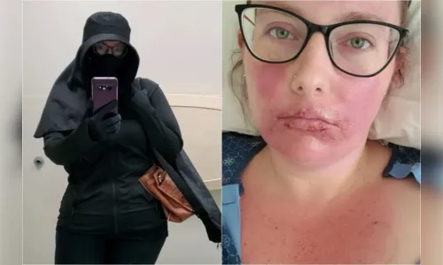 Mulher tem condição alérgica rara ao sol e relata “viver como vampira”