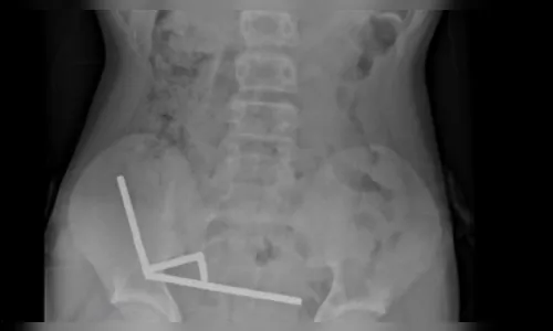 Adolescente de 13 anos engole 80 ímãs e perde parte do intestino