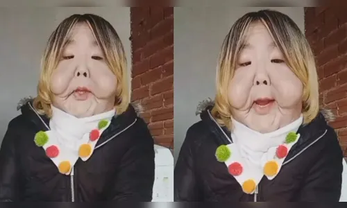 Influenciadora faz cirurgia após ter rosto deformado por procedimento