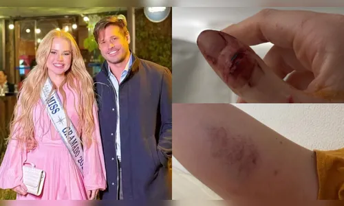 Ex de Dado Dolabella expõe fotos e acusa ator de agressões; veja