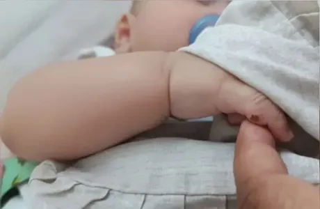 O bebê passou por uma frenectomia ao invés de operar o dedo