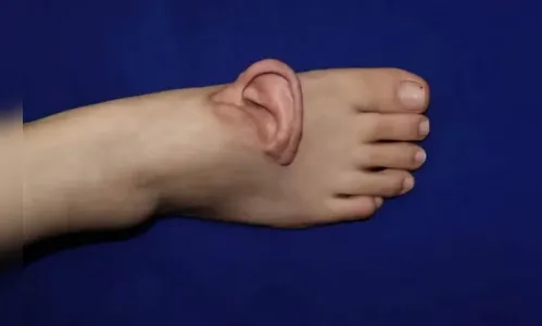 Médicos chineses enxertam orelha em pé de paciente após acidente