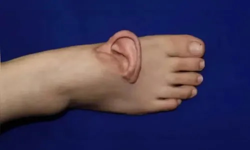 Médicos implantam orelha no pé de paciente na China; entenda