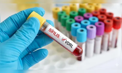 DNA de bactéria da sífilis com mais de 5 mil anos é encontrado por pesquisadores