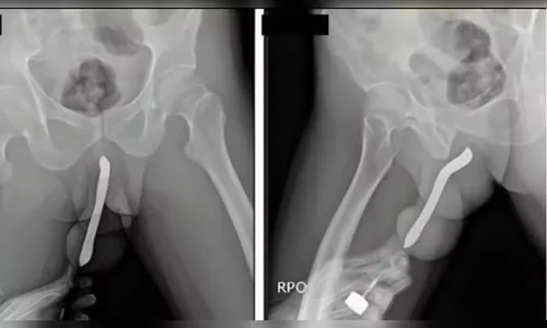 De bateria a sereia de plástico: veja os objetos mais inseridos em órgãos sexuais