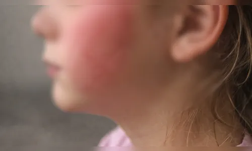 Pai é preso após agredir filha de 9 anos com chinelada no rosto