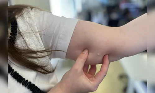 Procura por implante contraceptivo cresce 118% no SUS do Paraná em 2025