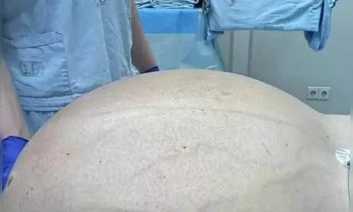 Médicos retiram tumor de quase 60 kg de paciente com 50 anos