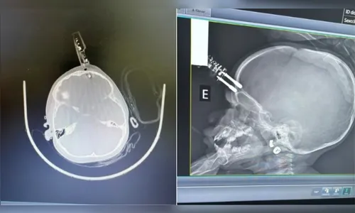 Bebê de 1 ano fica com carregador de celular cravado na testa após cair da cama