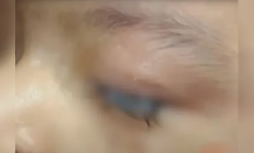 Criança de 2 anos vai parar no hospital após colar os olhos com cola industrial