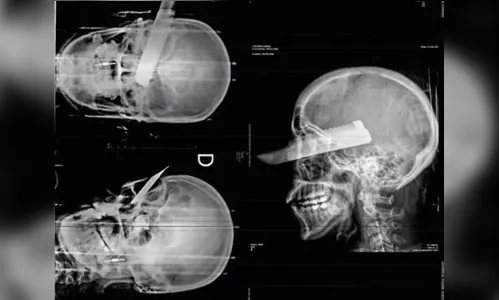 Mulher sobrevive após ter faca cravada no olho pelo companheiro em SC