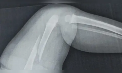 Polícia apura agressão contra bebê de um ano no PR após médicos acharem fratura antiga e lesão no fêmur