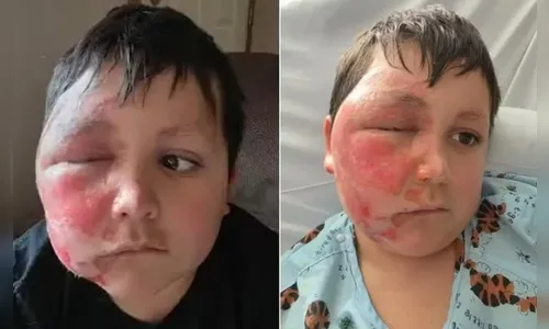Após desafio do TikTok, menino 9 anos fica com rosto deformado
