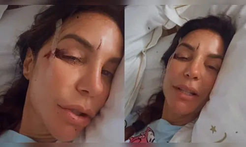 Ivete Sangalo surge no hospital e com o rosto machucado; saiba o que aconteceu