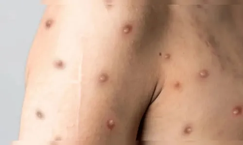 Primeiro registro de Mpox em 2026 acende alerta no Paraná