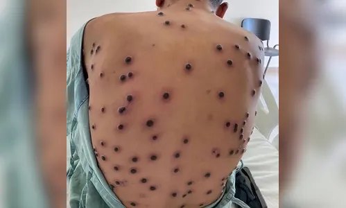 Brasil registra 88 casos de Mpox em 2026; saiba como evitar a doença