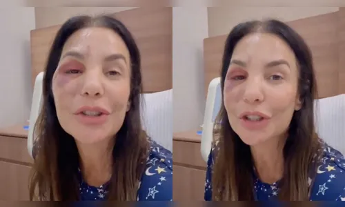 Ivete Sangalo fala sobre cirurgia no rosto após fratura; veja vídeo