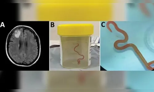 Parasita de cobras é encontrado em cérebro humano pela primeira vez