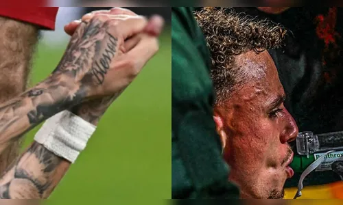 Jogador sofre amputação parcial de dedo após choque com placa em jogo da Champions